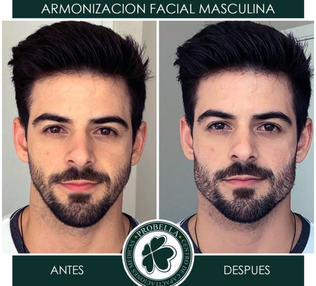 ARMONIZACION MASCULINA 10